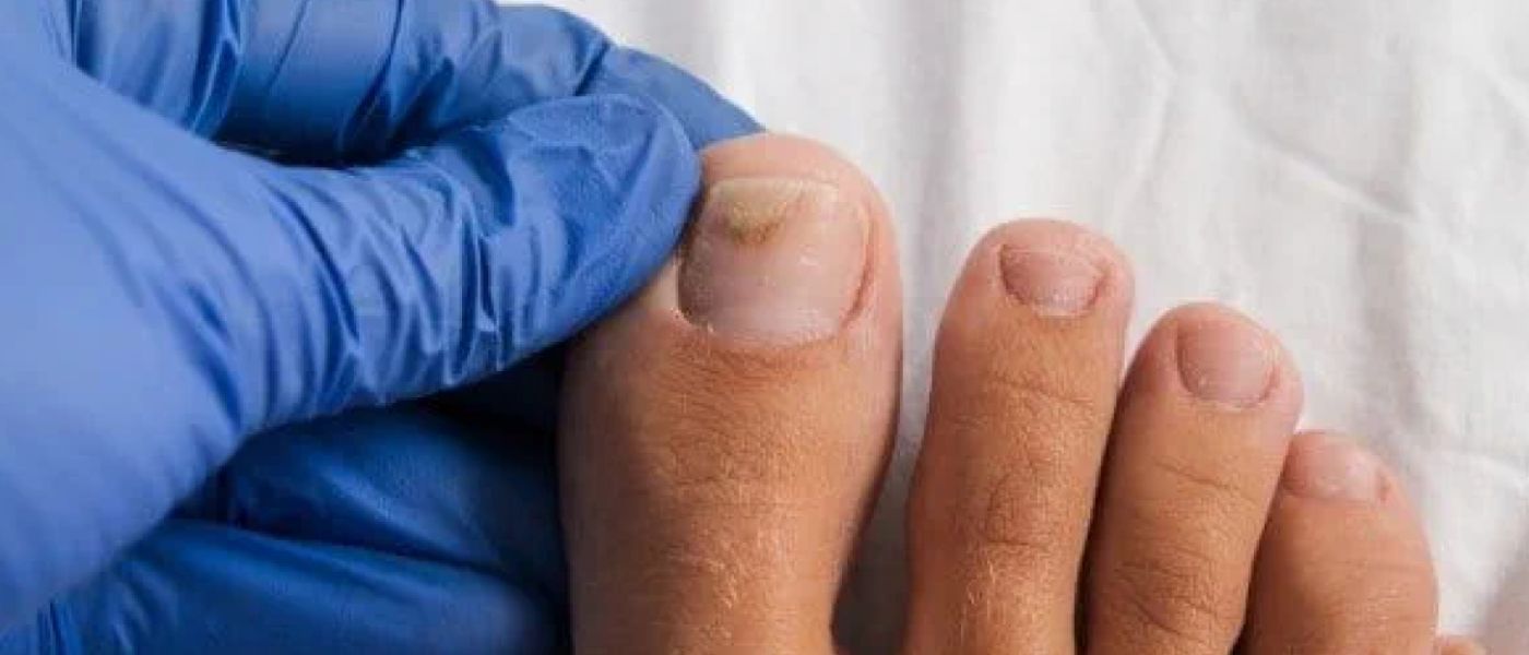 Ursache Nagelpilz